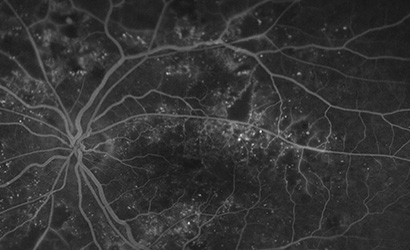 黄斑浮腫に対するナビゲーションレーザー