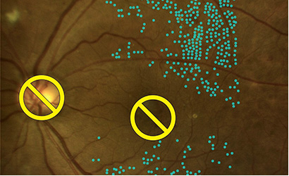 黄斑浮腫に対するナビゲーションレーザー