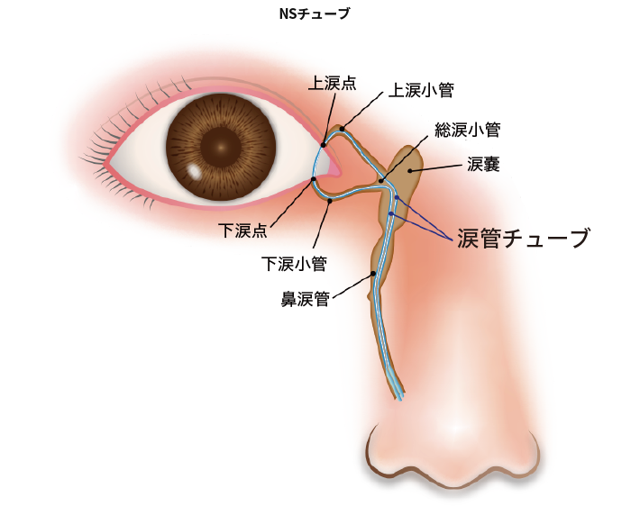 涙道狭窄・閉塞